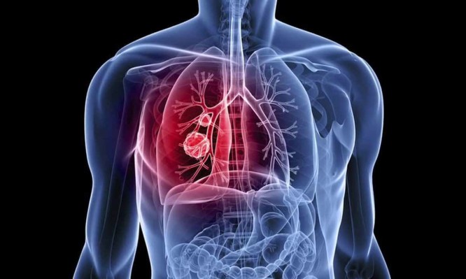 Καρκίνος του πνεύμονα: Τα συμπτώματα σε άνδρες και γυναίκες