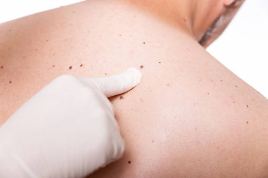 Kαρκίνος του δέρματος: Τα άτομα με αυτό το χαρακτηριστικό διατρέχουν μεγαλύτερο κίνδυνο
