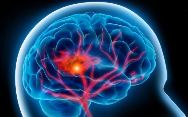 Εγκεφαλικό: Αιτίες και τρόποι αντιμετώπισης