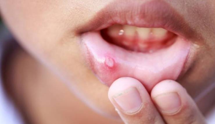 Καρκίνος του στόματος: Μεγάλη προσοχή στα κοινά συμπτώματα