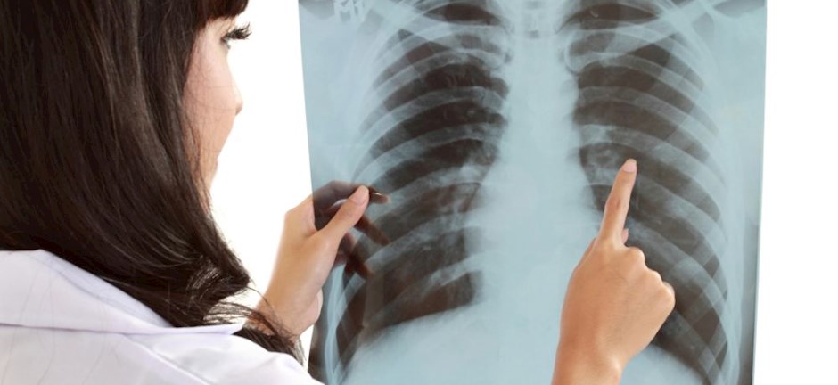 Φυματίωση: Συνεχίζονται οι προσπάθειες για την εξάλειψή της